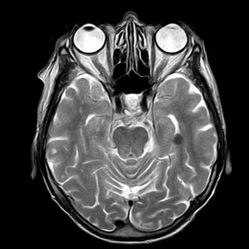 intraoperative neuromonitoring MRI